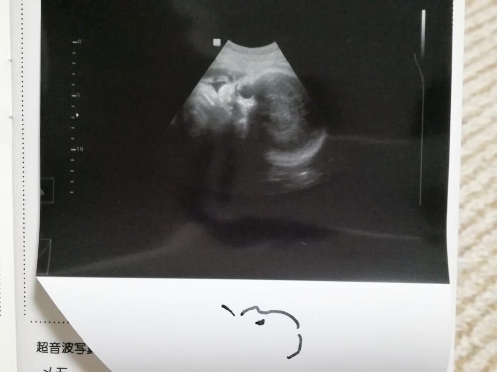 妊婦検診(32週目)